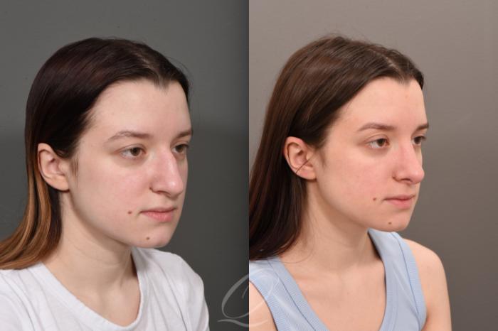 Rhinoplasty Case 1001562 Before & After Right Oblique | Serving Rochester, Syracuse & Buffalo, NY | Quatela Center for Plastic Surgery