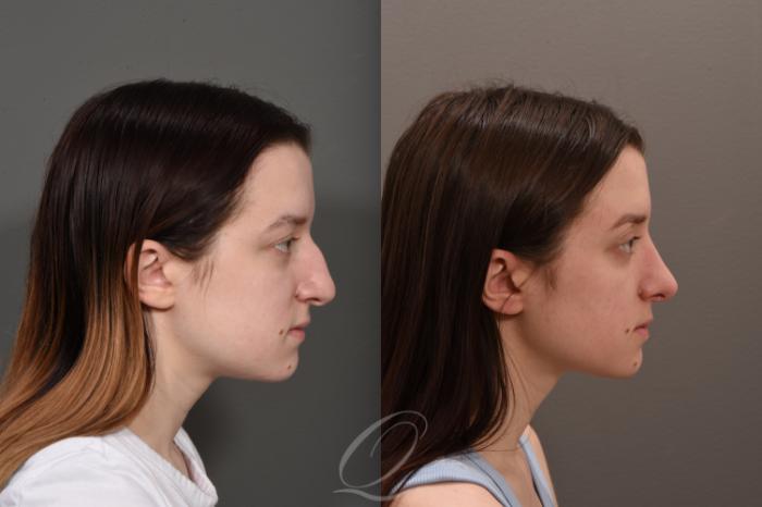 Rhinoplasty Case 1001562 Before & After Right Side | Serving Rochester, Syracuse & Buffalo, NY | Quatela Center for Plastic Surgery
