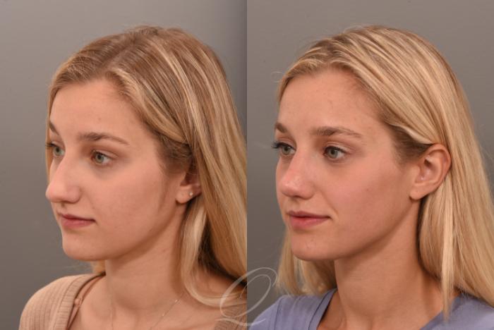 Rhinoplasty Case 1001616 Before & After Left Oblique | Serving Rochester, Syracuse & Buffalo, NY | Quatela Center for Plastic Surgery