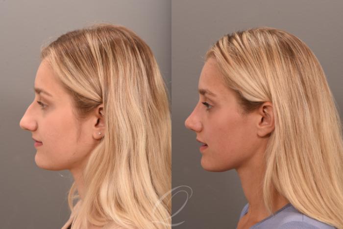 Rhinoplasty Case 1001616 Before & After Left Side | Serving Rochester, Syracuse & Buffalo, NY | Quatela Center for Plastic Surgery
