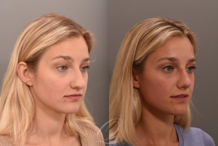 Rhinoplasty Case 1001616 Before & After Right Oblique | Serving Rochester, Syracuse & Buffalo, NY | Quatela Center for Plastic Surgery