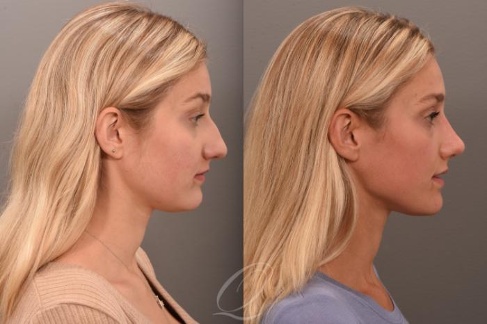 Rhinoplasty Case 1001616 Before & After Right Side | Serving Rochester, Syracuse & Buffalo, NY | Quatela Center for Plastic Surgery