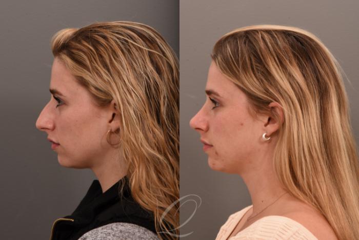 Rhinoplasty Case 1001617 Before & After Left Side | Serving Rochester, Syracuse & Buffalo, NY | Quatela Center for Plastic Surgery