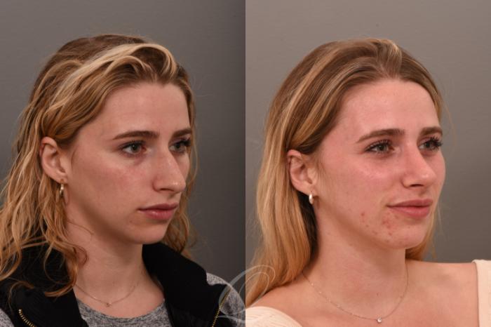 Rhinoplasty Case 1001617 Before & After Right Oblique | Serving Rochester, Syracuse & Buffalo, NY | Quatela Center for Plastic Surgery
