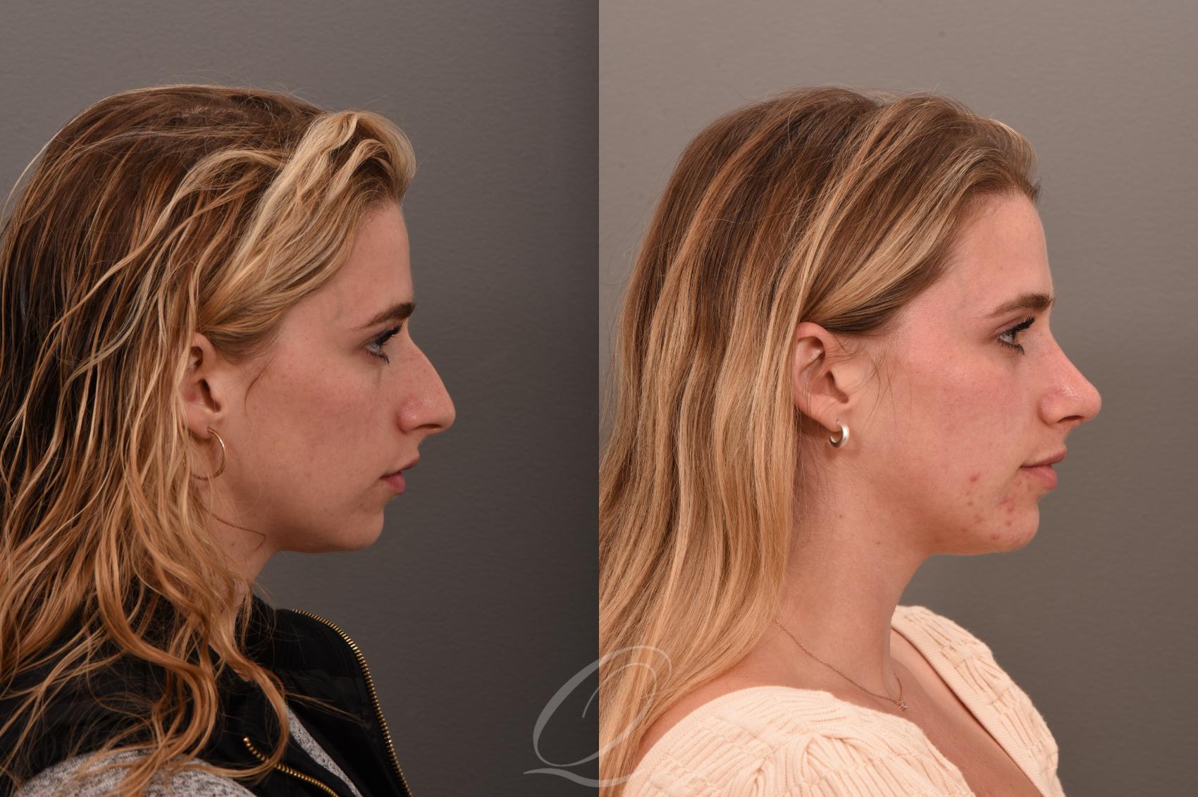 Rhinoplasty Case 1001617 Before & After Right Side | Serving Rochester, Syracuse & Buffalo, NY | Quatela Center for Plastic Surgery