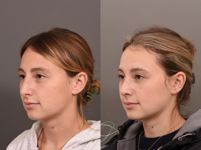 Rhinoplasty Case 1001643 Before & After Left Oblique | Serving Rochester, Syracuse & Buffalo, NY | Quatela Center for Plastic Surgery