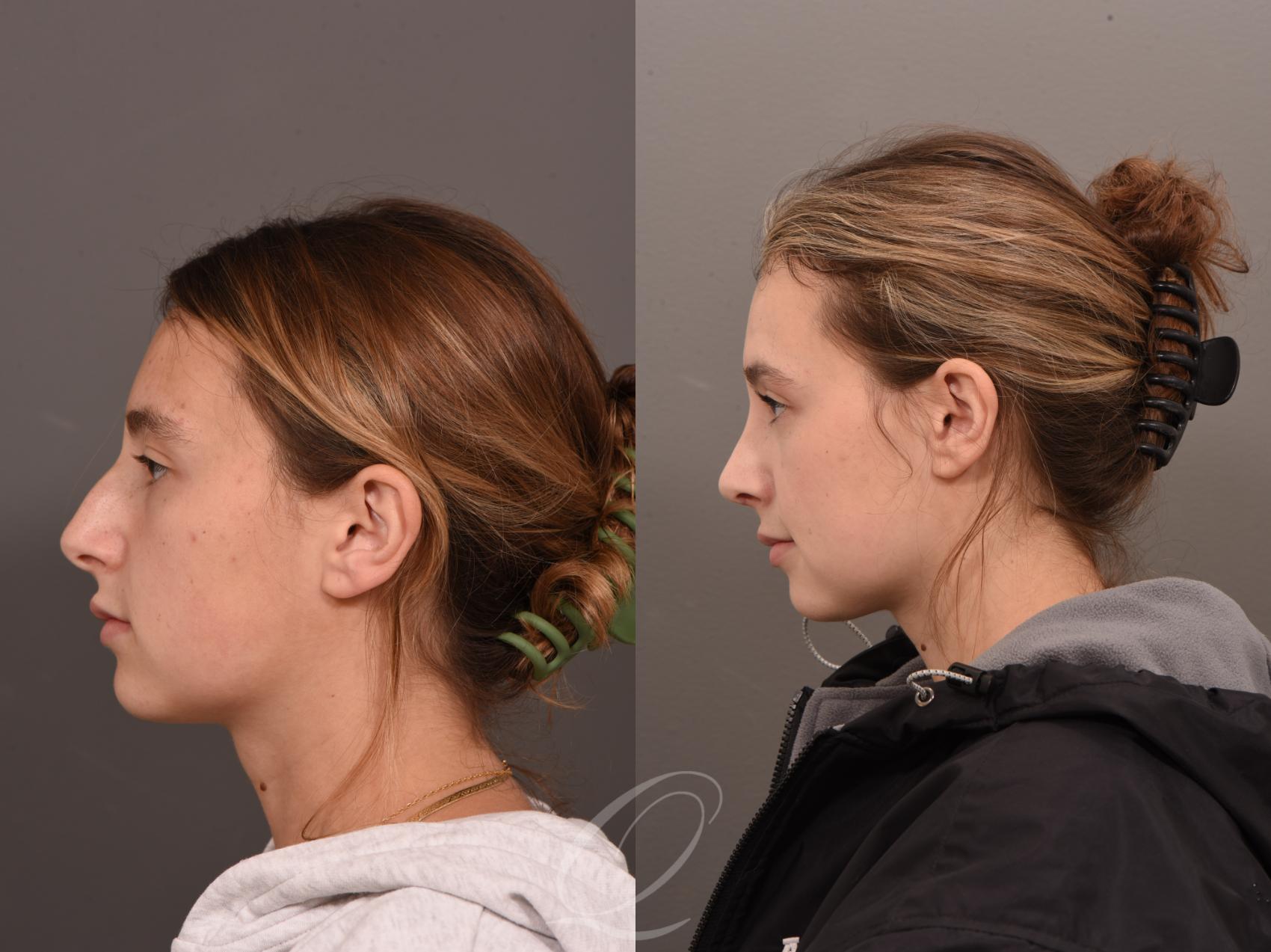 Rhinoplasty Case 1001643 Before & After Left Side | Serving Rochester, Syracuse & Buffalo, NY | Quatela Center for Plastic Surgery