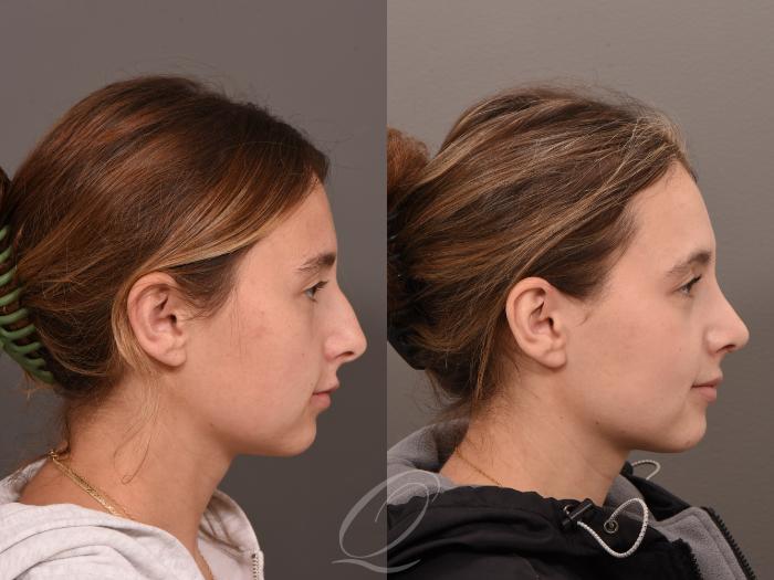 Rhinoplasty Case 1001643 Before & After Right Side | Serving Rochester, Syracuse & Buffalo, NY | Quatela Center for Plastic Surgery