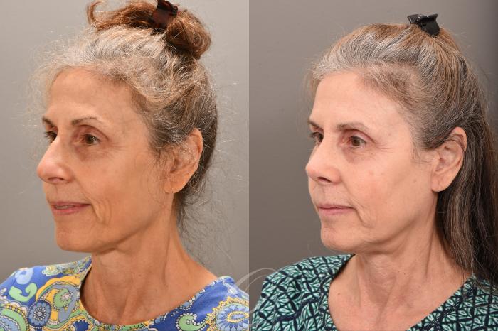 Rhinoplasty Case 1001710 Before & After Left Oblique | Serving Rochester, Syracuse & Buffalo, NY | Quatela Center for Plastic Surgery