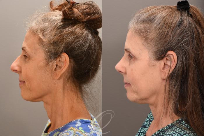 Rhinoplasty Case 1001710 Before & After Left Side | Serving Rochester, Syracuse & Buffalo, NY | Quatela Center for Plastic Surgery