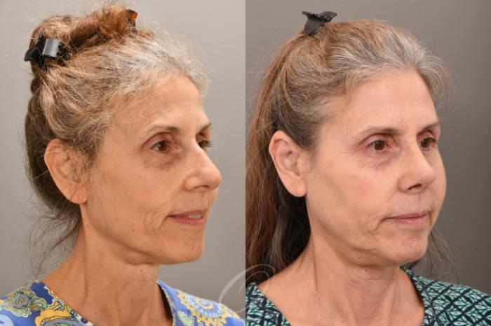 Rhinoplasty Case 1001710 Before & After Right Oblique | Serving Rochester, Syracuse & Buffalo, NY | Quatela Center for Plastic Surgery