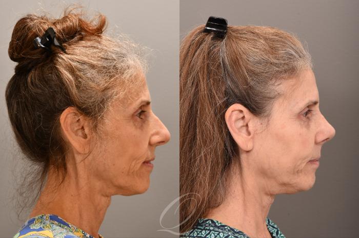 Rhinoplasty Case 1001710 Before & After Right Side | Serving Rochester, Syracuse & Buffalo, NY | Quatela Center for Plastic Surgery