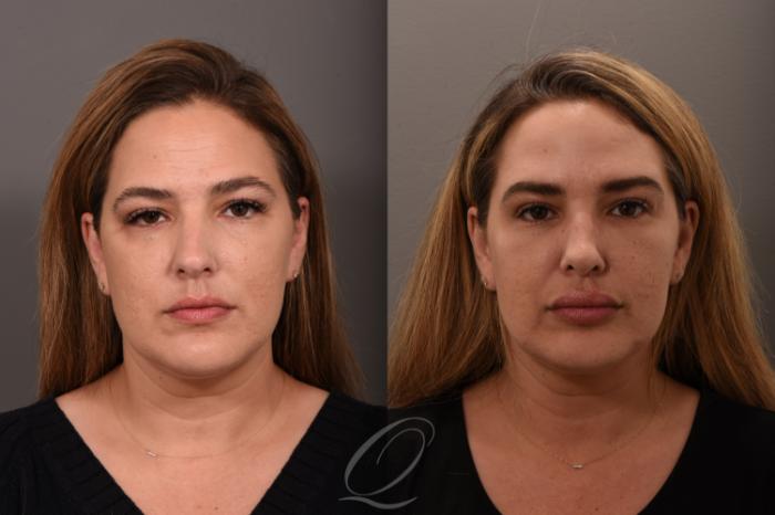 Rhinoplasty Case 1001724 Before & After Front | Serving Rochester, Syracuse & Buffalo, NY | Quatela Center for Plastic Surgery