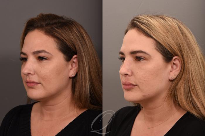 Rhinoplasty Case 1001724 Before & After Left Oblique | Serving Rochester, Syracuse & Buffalo, NY | Quatela Center for Plastic Surgery