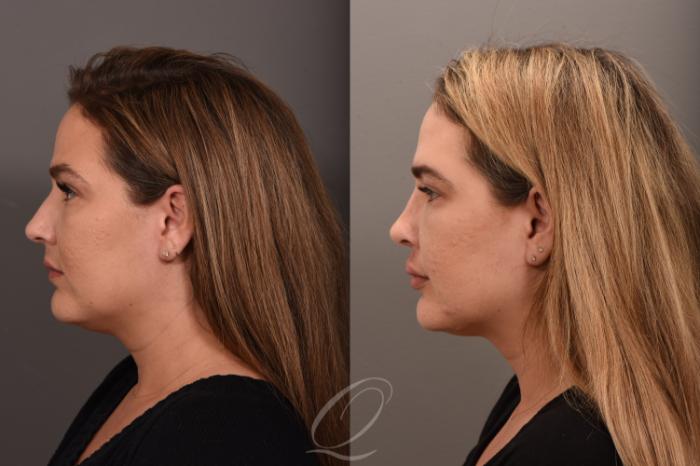 Rhinoplasty Case 1001724 Before & After Left Side | Serving Rochester, Syracuse & Buffalo, NY | Quatela Center for Plastic Surgery
