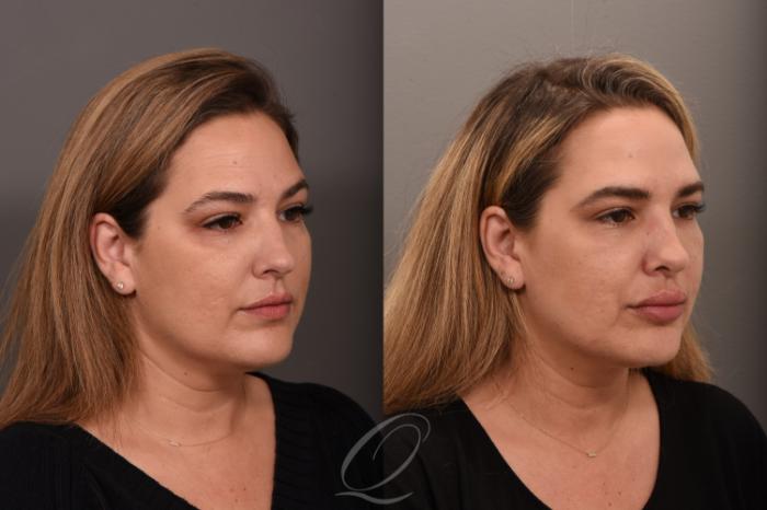 Rhinoplasty Case 1001724 Before & After Right Oblique | Serving Rochester, Syracuse & Buffalo, NY | Quatela Center for Plastic Surgery