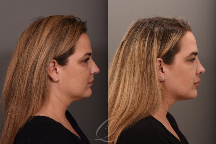 Rhinoplasty Case 1001724 Before & After Right Side | Serving Rochester, Syracuse & Buffalo, NY | Quatela Center for Plastic Surgery