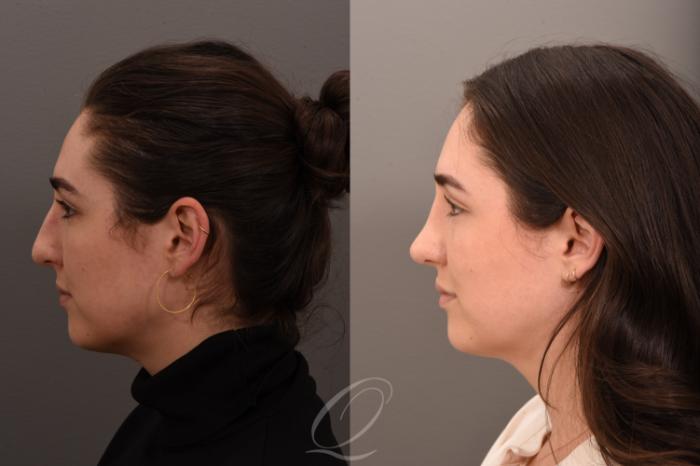 Rhinoplasty Case 1001725 Before & After Left Side | Serving Rochester, Syracuse & Buffalo, NY | Quatela Center for Plastic Surgery