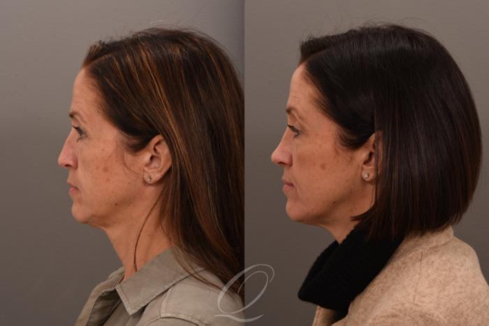 Revision Rhinoplasty Case 1001726 Before & After Left Side | Serving Rochester, Syracuse & Buffalo, NY | Quatela Center for Plastic Surgery
