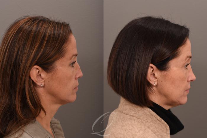 Revision Rhinoplasty Case 1001726 Before & After Right Side | Serving Rochester, Syracuse & Buffalo, NY | Quatela Center for Plastic Surgery