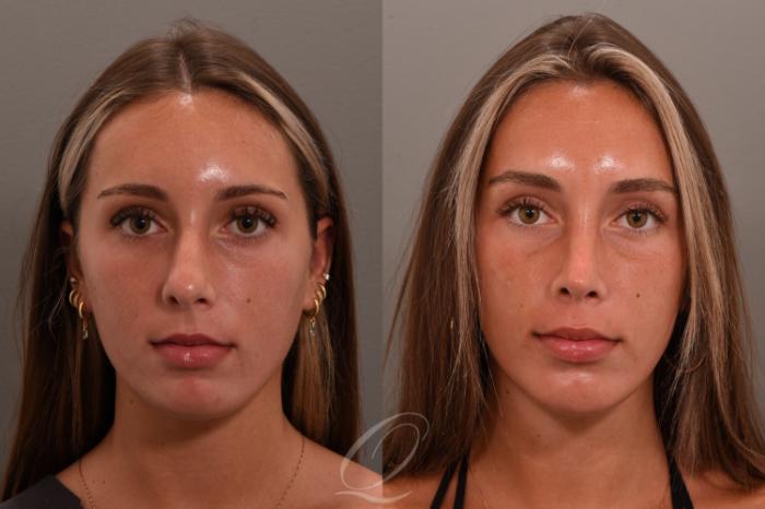 Rhinoplasty Case 1001748 Before & After Front | Serving Rochester, Syracuse & Buffalo, NY | Quatela Center for Plastic Surgery