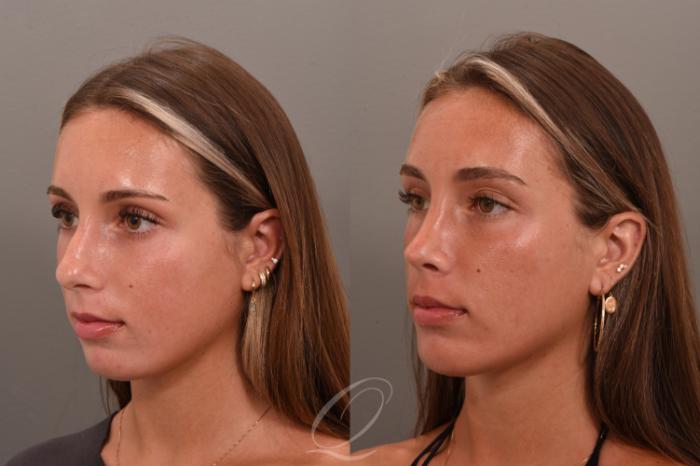 Rhinoplasty Case 1001748 Before & After Left Oblique | Serving Rochester, Syracuse & Buffalo, NY | Quatela Center for Plastic Surgery