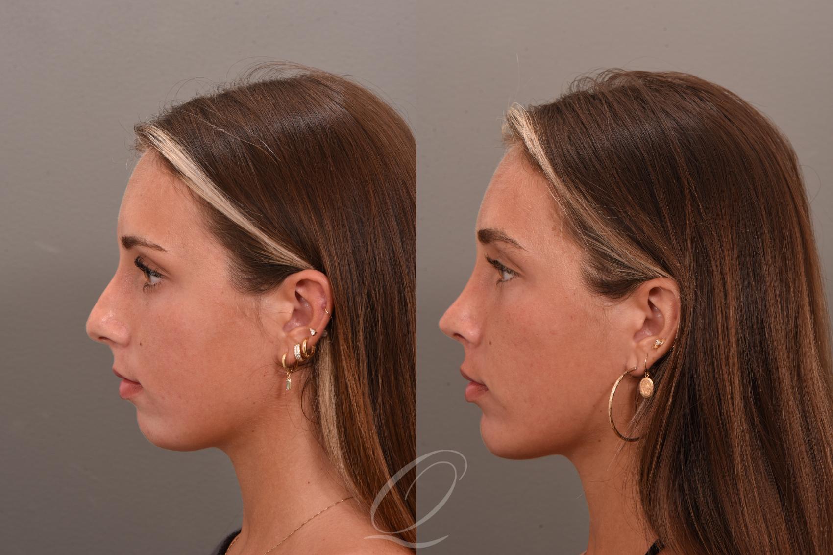 Rhinoplasty Case 1001748 Before & After Left Side | Serving Rochester, Syracuse & Buffalo, NY | Quatela Center for Plastic Surgery