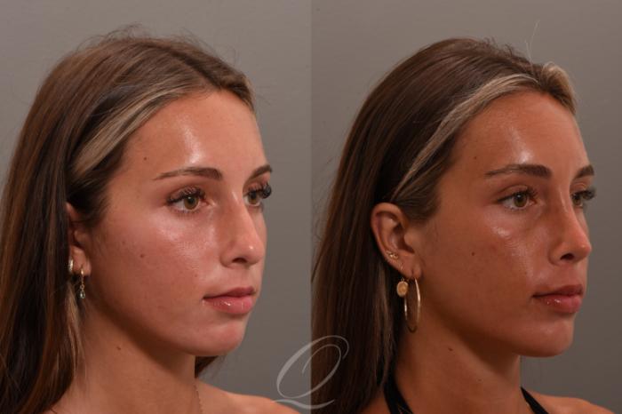 Rhinoplasty Case 1001748 Before & After Right Oblique | Serving Rochester, Syracuse & Buffalo, NY | Quatela Center for Plastic Surgery