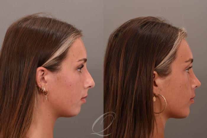 Rhinoplasty Case 1001748 Before & After Right Side | Serving Rochester, Syracuse & Buffalo, NY | Quatela Center for Plastic Surgery