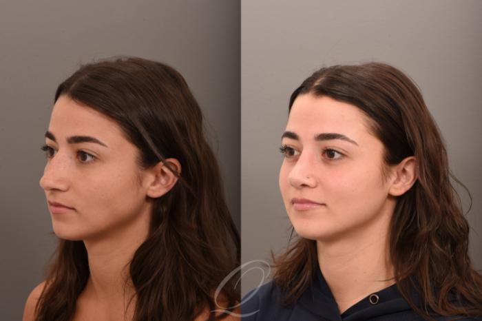 Rhinoplasty Case 1001755 Before & After Left Oblique | Serving Rochester, Syracuse & Buffalo, NY | Quatela Center for Plastic Surgery