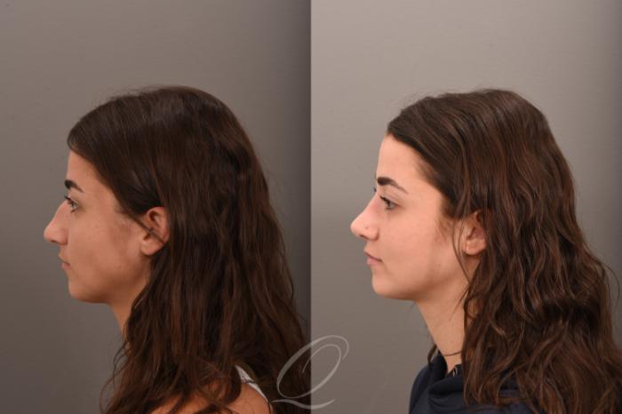 Rhinoplasty Case 1001755 Before & After Left Side | Serving Rochester, Syracuse & Buffalo, NY | Quatela Center for Plastic Surgery