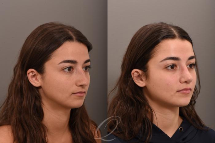 Rhinoplasty Case 1001755 Before & After Right Oblique | Serving Rochester, Syracuse & Buffalo, NY | Quatela Center for Plastic Surgery