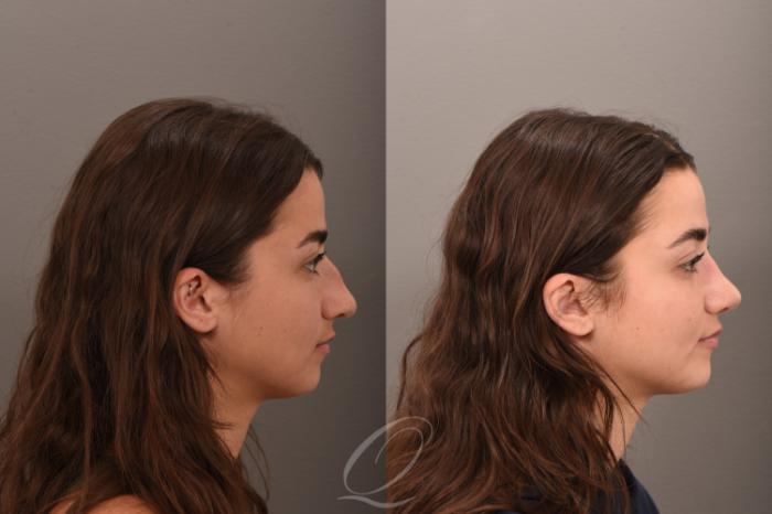 Rhinoplasty Case 1001755 Before & After Right Side | Serving Rochester, Syracuse & Buffalo, NY | Quatela Center for Plastic Surgery