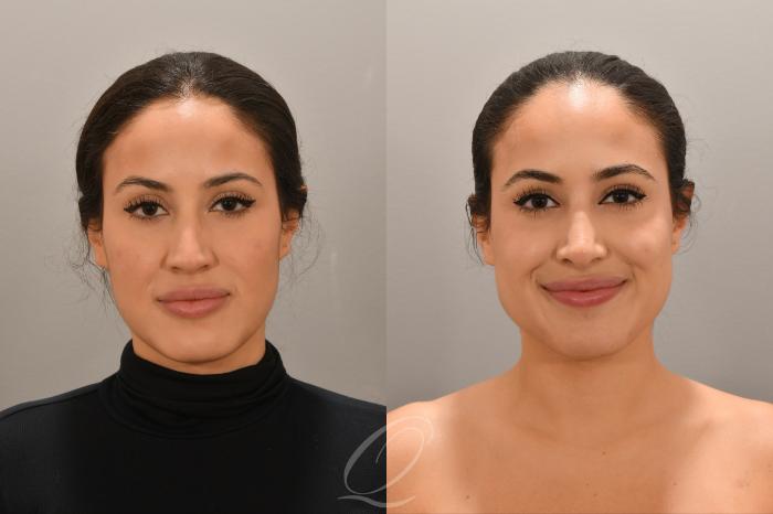 Rhinoplasty Case 1001770 Before & After Front | Serving Rochester, Syracuse & Buffalo, NY | Quatela Center for Plastic Surgery