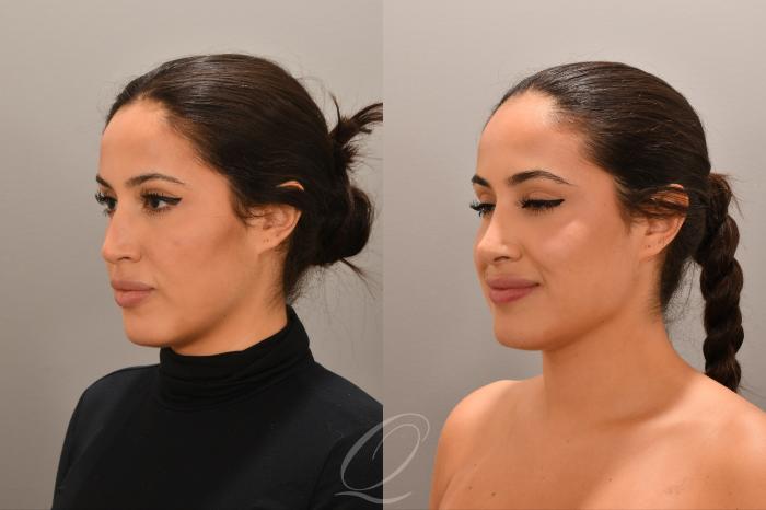 Rhinoplasty Case 1001770 Before & After Left Oblique | Serving Rochester, Syracuse & Buffalo, NY | Quatela Center for Plastic Surgery