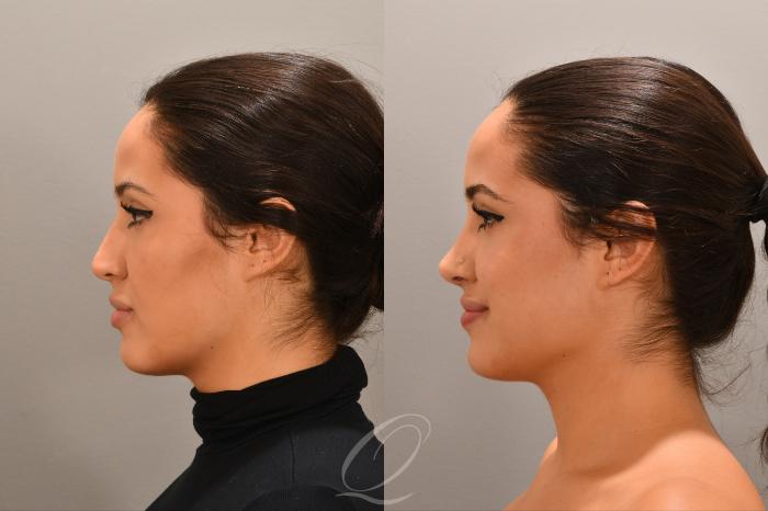 Rhinoplasty Case 1001770 Before & After Left Side | Serving Rochester, Syracuse & Buffalo, NY | Quatela Center for Plastic Surgery