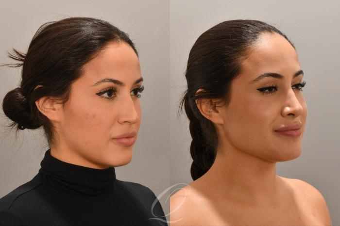 Rhinoplasty Case 1001770 Before & After Right Oblique | Serving Rochester, Syracuse & Buffalo, NY | Quatela Center for Plastic Surgery