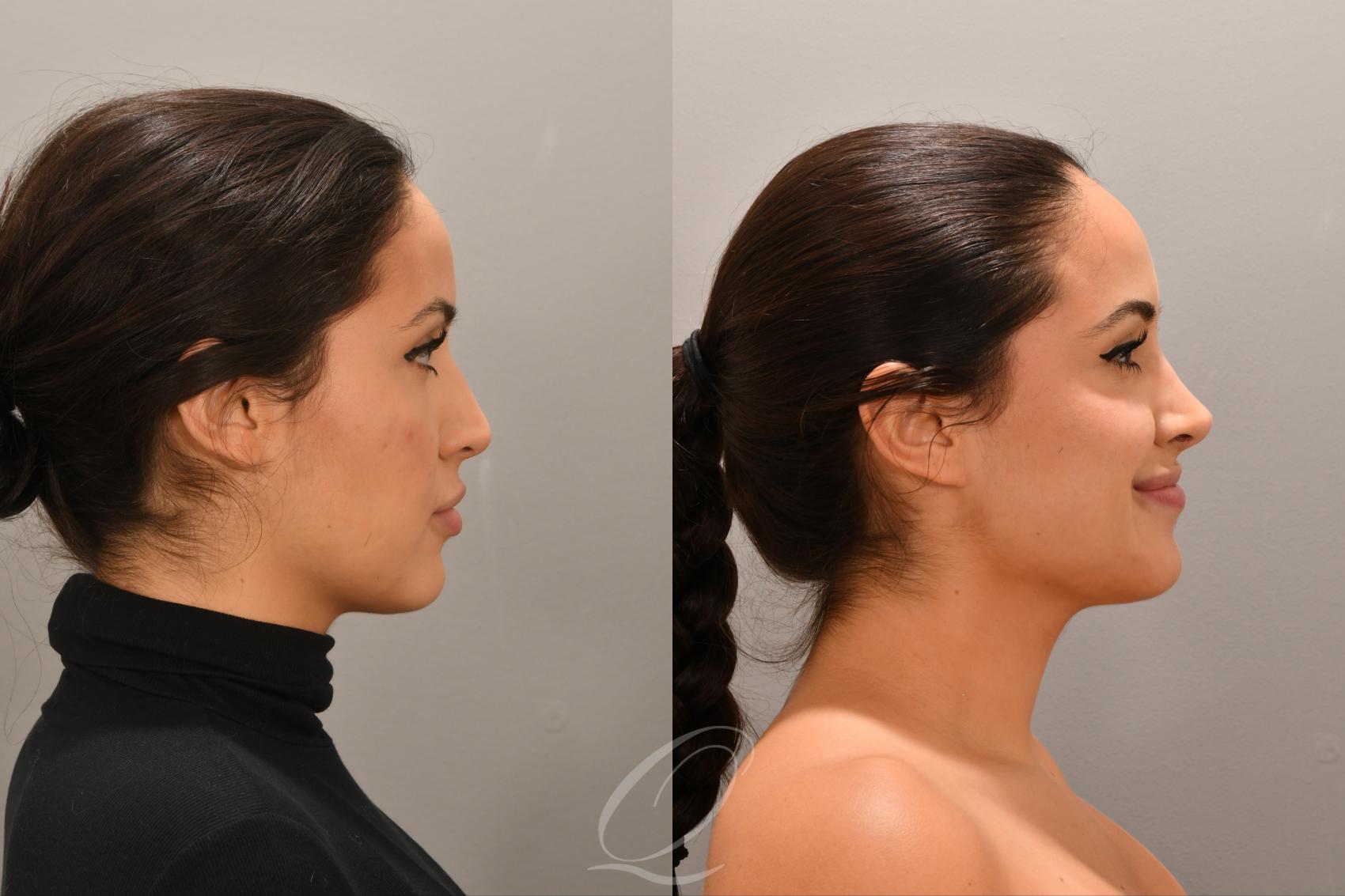 Rhinoplasty Case 1001770 Before & After Right Side | Serving Rochester, Syracuse & Buffalo, NY | Quatela Center for Plastic Surgery