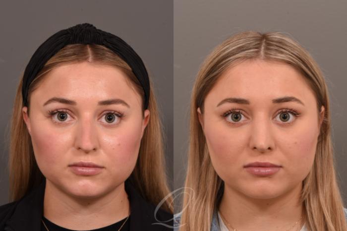 Rhinoplasty Case 1001775 Before & After Front | Serving Rochester, Syracuse & Buffalo, NY | Quatela Center for Plastic Surgery