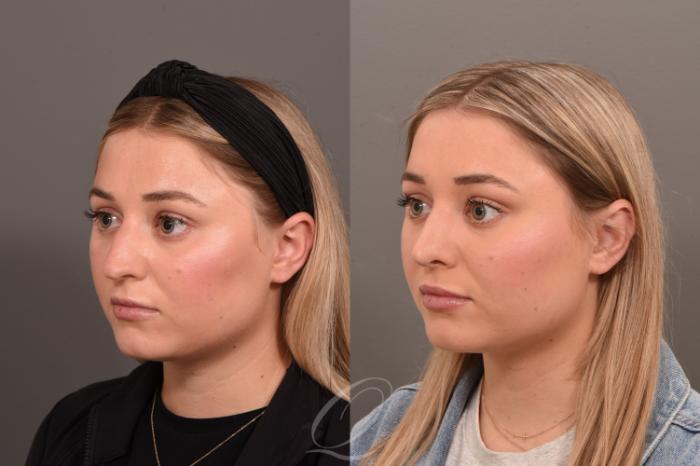 Rhinoplasty Case 1001775 Before & After Left Oblique | Serving Rochester, Syracuse & Buffalo, NY | Quatela Center for Plastic Surgery