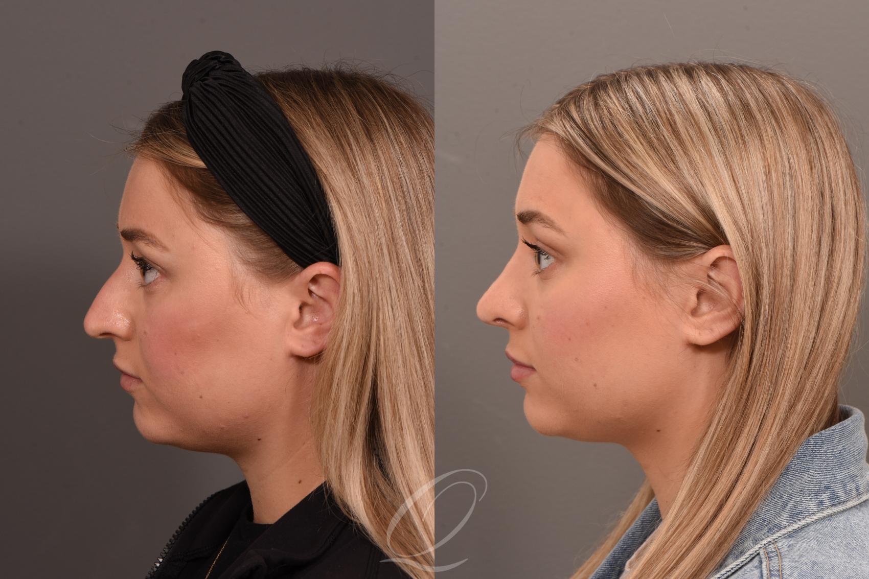 Rhinoplasty Case 1001775 Before & After Left Side | Serving Rochester, Syracuse & Buffalo, NY | Quatela Center for Plastic Surgery