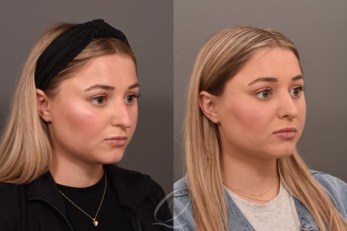 Rhinoplasty Case 1001775 Before & After Right Oblique | Serving Rochester, Syracuse & Buffalo, NY | Quatela Center for Plastic Surgery