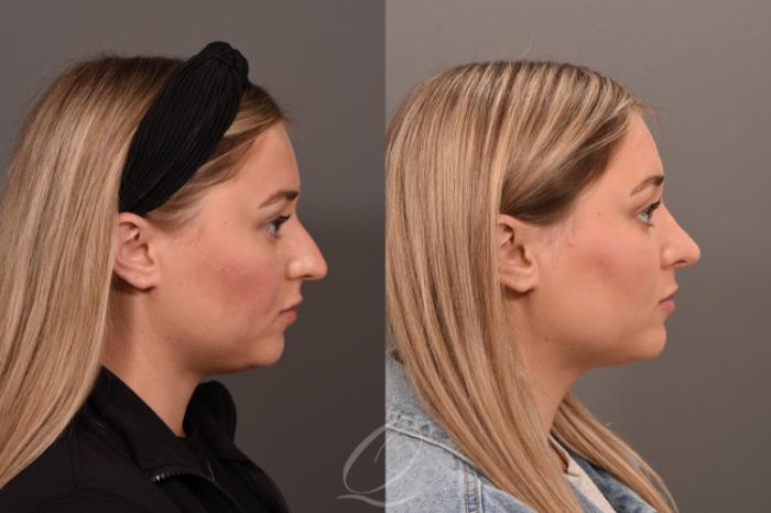 Rhinoplasty Case 1001775 Before & After Right Side | Serving Rochester, Syracuse & Buffalo, NY | Quatela Center for Plastic Surgery