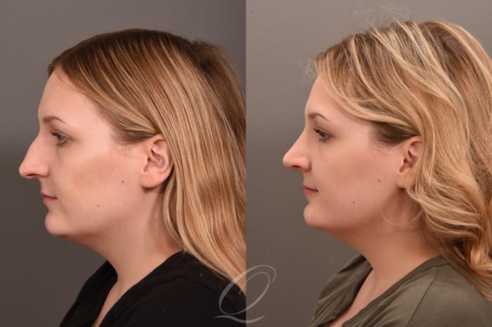Rhinoplasty Case 1001835 Before & After Left Side | Serving Rochester, Syracuse & Buffalo, NY | Quatela Center for Plastic Surgery