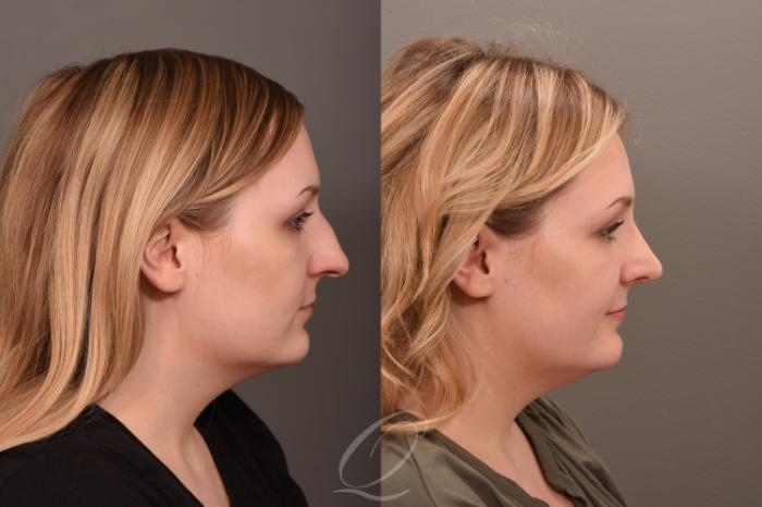 Rhinoplasty Case 1001835 Before & After Right Side | Serving Rochester, Syracuse & Buffalo, NY | Quatela Center for Plastic Surgery