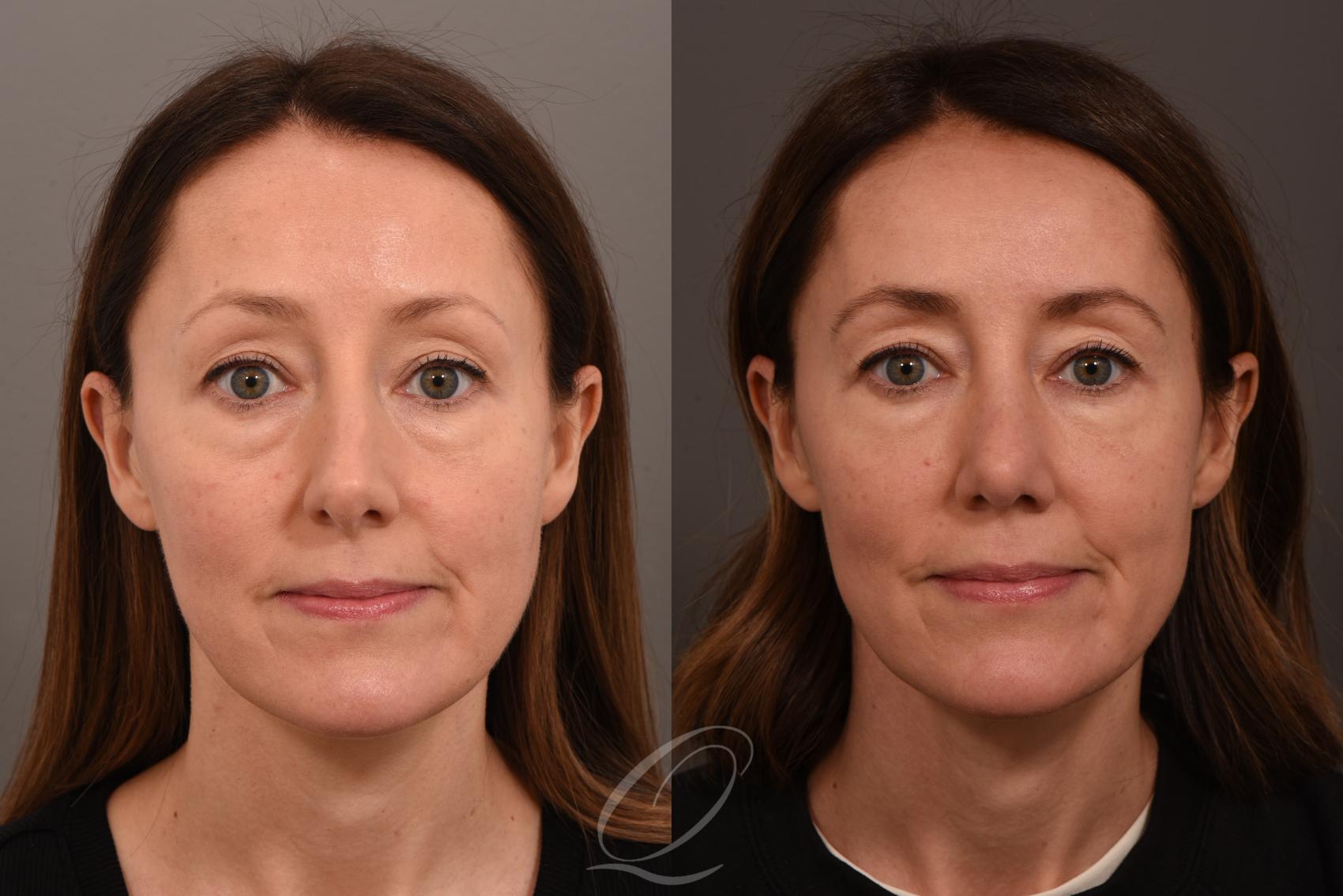 Rhinoplasty Case 1001839 Before & After Front | Serving Rochester, Syracuse & Buffalo, NY | Quatela Center for Plastic Surgery