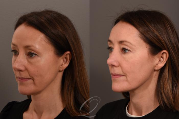 Rhinoplasty Case 1001839 Before & After Left Oblique | Serving Rochester, Syracuse & Buffalo, NY | Quatela Center for Plastic Surgery