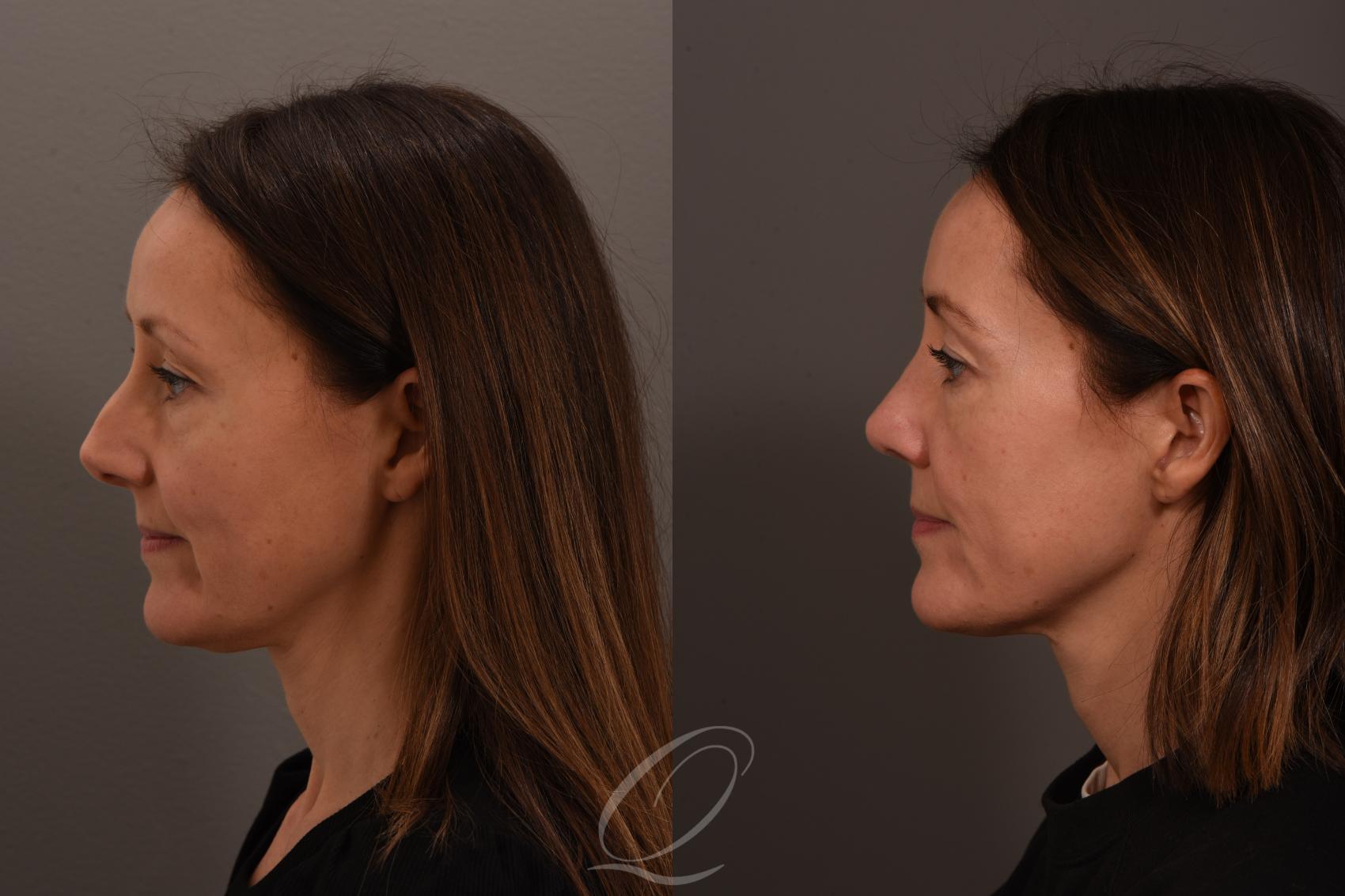 Rhinoplasty Case 1001839 Before & After Left Side | Serving Rochester, Syracuse & Buffalo, NY | Quatela Center for Plastic Surgery