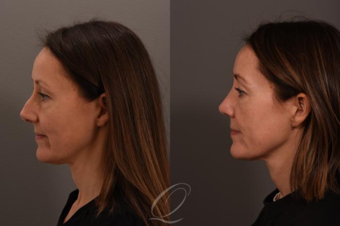 Rhinoplasty Case 1001839 Before & After Left Side | Serving Rochester, Syracuse & Buffalo, NY | Quatela Center for Plastic Surgery