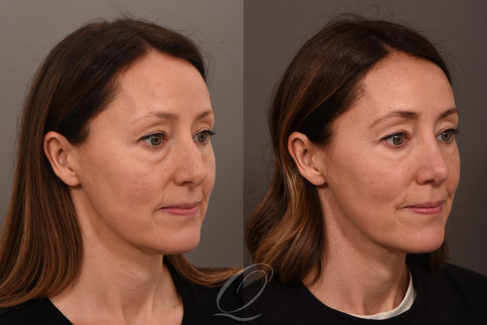 Rhinoplasty Case 1001839 Before & After Right Oblique | Serving Rochester, Syracuse & Buffalo, NY | Quatela Center for Plastic Surgery